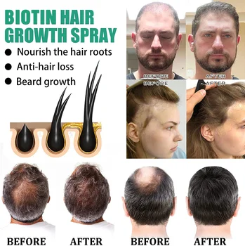 iBeaLee Продукти За Растежа на Косата, Биотин Бързо развиващ се Грижа За Коса Етерични Масла Срещу Косопад Спрей За Лечение на Кожата на Главата За Мъже Жени 3