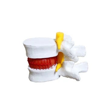 Модел на лумбалните прешлени на гръбнака межпозвоночный диск Протрузия на Лумбалните прешлени скелет на 